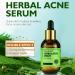 Rosarden Anti Acne Serum for Face Natural Herbal Face Serum for Improvement Pimples Pore Acne Scar Anti Pimple Serum Face Care for All Skin Types of Acne - Buy Online on GoSupps.com