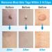 Painless 2-in-1 Skin Tag Removal Kit for Micro to Large Skin Tags (1-9mm) - Safe & Easy DIY Tool for Home Use - Buy Online on GoSupps.com