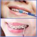 6 Pcs Double Ended Orthodontic Toothbrushes for Braces - Teen & Adult Manual Toothbrushes - Buy Online on GoSupps.com