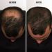 Dark Brown ECLIPSE Hair Fibers 60g - Instantly Conceal Hair Loss - Men & Women - 100% Undetectable - Buy Online on GoSupps.com