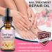 Fungal Nail Treatment - Toe Nail Fungal Treatment - Nail Fungus Treatment for Toenail and Fingernails - Anti fungus Nail Repair and Strengthen Fix & Renew Damaged Broken Nails - Buy Online on GoSupps.com