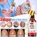 Nail Fungus Treatment for Toenail - 7 Day Fungal Nail Treatment for Toenails Extra Strong - Fungal Nail Treatment - Toenail Fungus Treatment for Thickening Yellow-Brown Discoloration Ragginess 10ML - Buy Online on GoSupps.com