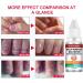 Fungal Nail Treatment Nail Fungus Treatment for Toenail Ingrown Toenail Treatment Toe Nail Fungal Treatment Fungal Nail Treatment for Toenails Extra Strong Nail Repair Treatment Repairing Broken Nail - Buy Online on GoSupps.com