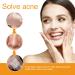Pimple Patches for Face Hydrocolloid Surface Patches for Forehead Nose Chin and Cheeks Large Acne Treatment Patches for Pimple Extraction and Clean Pores Hydrocolloid Acne Patches for Acne Skin - Buy Online on GoSupps.com