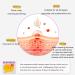 Azelaic Acid 12% Azelaic Acid For Face Serum Rich in Niacinamide and Hyaluronic Acid Fades Post Acne Marks and Calms Redness Formula for Uneven and Blemish Prone Skin Care Unflavored - Buy Online on GoSupps.com