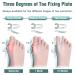 Bunion Corrector for Women & Men - Orthopedic Toe Straightener & Splint for Hallux Valgus - Bunion Relief Brace with 3 Angle Fixing Plates - Buy Online on GoSupps.com