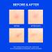 RIGHT AWAY Microtip Hydrocolloid Acne Pimple Patch - Fast-Acting Treatment for Early Zits & Hidden Blemishes (8 Patches - Buy Online on GoSupps.com