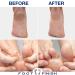 Foot Finish Athlete's Foot Treatment Cream - 4oz | Natural Anti-Itch Relief for Dry Cracked Feet with Tea Tree, Rose & Lavender Oil - Buy Online on GoSupps.com