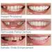 2 Pairs of Instant Veneers Dentures - Temporary False Teeth for Whitest Smile | Cosmetic Above & Below Tooth Covers - Buy Online on GoSupps.com