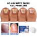 Pack of 2 Nail Care Device Therapy Nail Fungus Laser Therapy The Revolutionary and Highly Effective Light Therapy for Treating Toenail Diseases Cleaning and Care of Nails - Buy Online on GoSupps.com