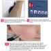 Generous Spider Vein Removal Device | High-Frequency Facial & Leg Treatment | Home Salon Beauty Equipment - Buy Online on GoSupps.com