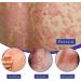 EXQST Herbal Psoriasis Relief Spray - Treatment for Skin Plaque Psoriasis (5pcs) - Buy Online on GoSupps.com