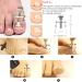 JTIEO 9PCS Toenail Clippers | Stainless Steel Ingrown Toenail Removal Kit | Professional Ingrown Toenail Treatment Tool Set - Buy Online on GoSupps.com