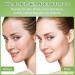 Eofot 14% Azelaic Acid Acne Cream Azelaic Acid For Face Helps Improve the Appearance of Acnes - Azalecic Acids Acido Azelaico 1 Fl Oz - Buy Online on GoSupps.com