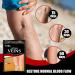 OTBK Varicose Vein Treatment Patch (36pcs) | Leg Spider Vein Removal | Improve Blood Circulation & Relieve Fatigue | One Size - Buy Online on GoSupps.com