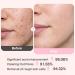 Glycolic Acid 20% Resurfacing Pads (50 Count), Exfoliating Peel Pads for Face, Skin Pore Resurfacing & Radiance, Exfoliating Toner Facial Pads with Oil, Salicylic Acid & Vitamins E, B3, B5 Pink 50 Count (Pack of 1) - Buy Online on GoSupps.com