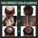 Accelerate Hair Growth Serum | Anti-Hair Loss for Men & Women | Promotes Thicker Fuller Hair - Buy Online on GoSupps.com