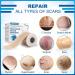 Scar Away Silicone Scar Sheets - 1.6 x 60 Roll - Surgical, C-Section, Keloid, Tummy Tuck, Burn, Stretch Marks - Reusable Scar Removal Strips - Buy Online on GoSupps.com