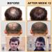 Minoxidil 5% Foam for Men with Biotin - Hair & Beard Growth Treatment (3 Pack) - Buy Online on GoSupps.com