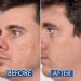 Particle Silicone Scar Gel - Advanced Remover (1.01 Oz) - Surgical, Acne, Burn, & Cut Scar Treatment - Enhances Appearance, Color & Texture - Buy Online on GoSupps.com