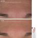 Trophy Skin MiniMD Handheld Microdermabrasion System - Enhances Texture and Skin Tone - Buy Online on GoSupps.com