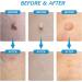 Skin Tag Remover Kit - Safe & Easy 2 in 1 Auto Removal Pen for Small to Large Skin Tags - Home Use - Blue - Buy Online on GoSupps.com