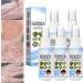 BEESO Melllop Herbal Psoriasis Relief Spray Herbal Psoriasis Relief Spray Psoriasis Ointment for Itchy Skin Rejuvenate The Skin (5pcs)