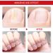Fungal Nail Treatment - Nail Fungus Treatment for Toenail - Extra Strong Nail Fungus Treatment for Toenail - Anti fungus Nail Repair and Strengthen Fix & Renew Damaged Broken Nails - Buy Online on GoSupps.com