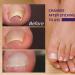 Grgowe Nail Correction Ingrown Toenail Corrector Foot Toenail Plasters Foot Correction Foot Toenail Correction for Care of Toenail Treatment Protect - Buy Online on GoSupps.com