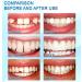 Gokame Tooth Repair Granules - Reusable Temporary Dental Repair Kit for Missing & Broken Teeth (20ml) - Buy Online on GoSupps.com