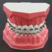 Dental Orthodontic Model with Metal Brackets, Arch Tubes, and Ligature Ties - Standard Size for Teaching and Study - Buy Online on GoSupps.com