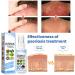 DUBUSH Melllop Herbal Psoriasis Soothing Mist - Skin Rejuvenating Psoriasis Treatment - 3pcs - Buy Online on GoSupps.com
