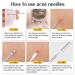 Nacerlary 10-Piece Needle Tweezers Blackhead Puller Tool Set - Best Acne Removal & Skincare Solution - Buy Online on GoSupps.com