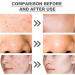 Azelaic Acid Suspension 10% Face Serum Azelaic Acid Serum Cream with Niacinamide & Vitamin C Anti Acne Cream Face Serum for Women Hydrating Serums Skincare to Reduces Blackheads Anti Aging Serum - Buy Online on GoSupps.com