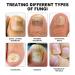 Furzero Pureail Nail Fungus Laser Therapy Device - Effective Fungus Treatment for Healthy Nails | Fast International Shipping - Buy Online on GoSupps.com