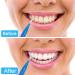DHWEKU 6PC Aligner Removal Tool Set - Invisible Tooth Remover & Cleaner for Braces | Oral Care with 3 Cleaning Brushes - Buy Online on GoSupps.com