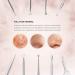 Blackening Remover for Pimples - Stainless Steel 6-Piece Izuku Blackhead Extractor Set | Comedone Squeezer for All Skin Types - Buy Online on GoSupps.com