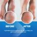 Callus Remover for Feet Extra Strength with Stainless Steel Foot File (Pedicure Grade) - Professional Foot Rasp Callus Remover Softener - Callus Treatment Heels and Hands - Cuticle Remover & Softener - Buy Online on GoSupps.com