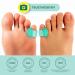 Buy Welnove Gel Toe Spreader - 12-Pack Small Toe Cushions & Sleeves for Friction Relief (Green) | International Shipping Available - Buy Online on GoSupps.com