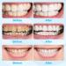 Douceur Teeth Whitening Kit - 5 Whitening Gels, 16 LED Lights - Non-Sensitive, Pain-Free Home & Travel Whitening Solution - Buy Online on GoSupps.com