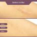 Professional Silicone Scar Sheets for C-Section, Surgical, Burn, Keloid & Acne Scars - 1.6 x 120 Roll - Buy Online on GoSupps.com