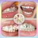 Tpyag Dental Rhinestones Dental Rhinestone Kit Crystal Decoration Set for Teeth Removable Shiny Tooth Ornaments Dental Decor - Buy Online on GoSupps.com