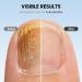 Buy Nail Fungus Light Device for Home Use - Treat Onychomycosis on Fingernails & Toenails | Effective for Damaged Discolored & Thickened Nails - Buy Online on GoSupps.com