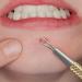 SC-11103-GLD Suvorna Whitehead Remover | Effective Pimple & Cyst Removal Tool for Clear Skin - Buy Online on GoSupps.com
