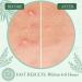 Buy SIMPLIFUL LIFE Hydrocolloid Acne Pimple Miracle Patch - 216 Count Effective Zit & Blemish Treatment International Shipping Available - Buy Online on GoSupps.com