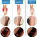 Veinshealth Varicose Veins Blue Light Therapy Set - Treatment for Legs, Spider Veins and Varicose Vein, Cream + Pen Included - Buy Online on GoSupps.com