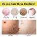 Stretch Mark Cream Prevention Stretch Mark Cream Skin Hydration Whitening Specialized Care for Stretch Marks Dry Skin and Irregular Skin Fragrance Free - Buy Online on GoSupps.com