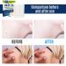 Skin Tag Remover Patch 144 PCS | Safe & Effective Skin Tag Removal Patches | 144 pcs/box - Buy Online on GoSupps.com