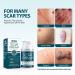 Metetas Advanced Scar Cream 1.7 Oz - Silicone Scar Gel for Surgical, C-Section, Stretch Marks, Keloids & Burns - Effective Treatment for Old & New Scars - 50ml - Buy Online on GoSupps.com