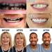 Buy 10 Pairs of Silicone Cosmetic False Teeth Veneers - Ideal Fake Tooth Covers for Men & Women | Provisional Dentures for a Perfect Smile - Buy Online on GoSupps.com